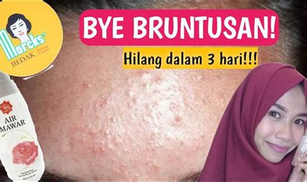 Cara Mengatasi Bruntusan Di Wajah